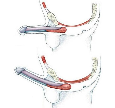 Penis without pubococcygeus muscle training and after