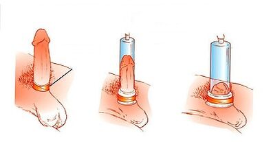 The operating principle of the pump to increase the penis