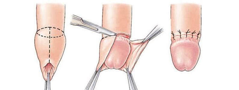 The effect of circumcision on the size of the penis
