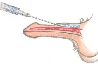 A dangerous method of penis enlargement using vaseline injections